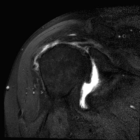 Locked anterior MRI 1